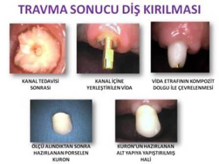 vida destekli porselen kuron