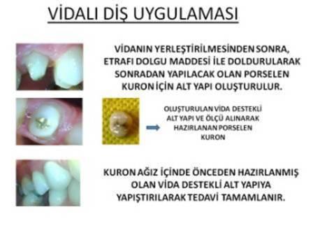 vidalı diş nasıl yapılır?