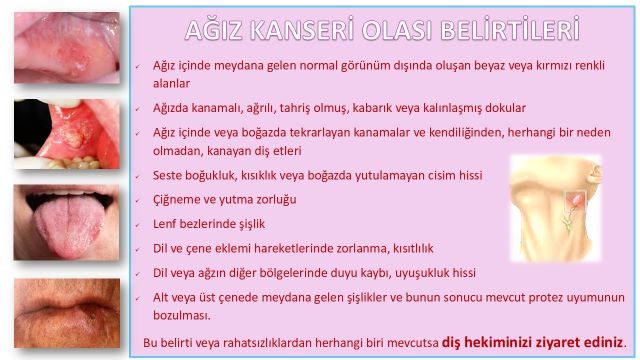 ağız içindeki kanserin belirtileri